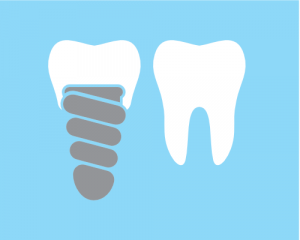 dental implants